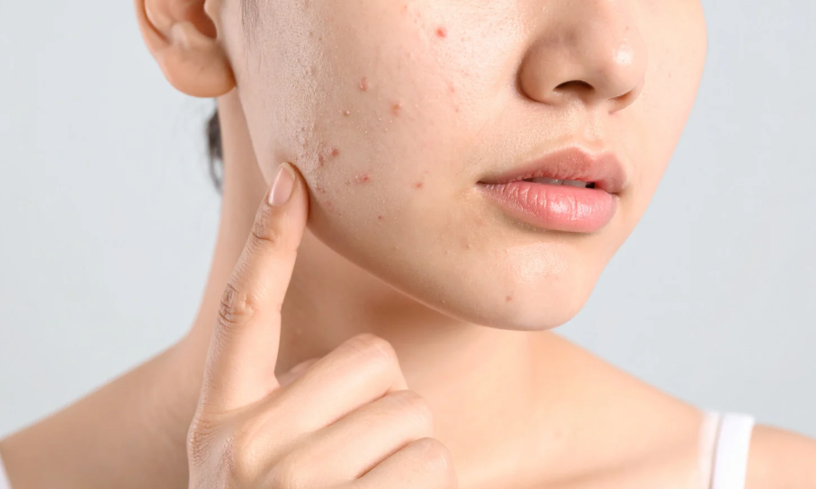 ニキビケアにおすすめの漢方薬7選｜効果効能や注意点、日ごろからできるケアを解説