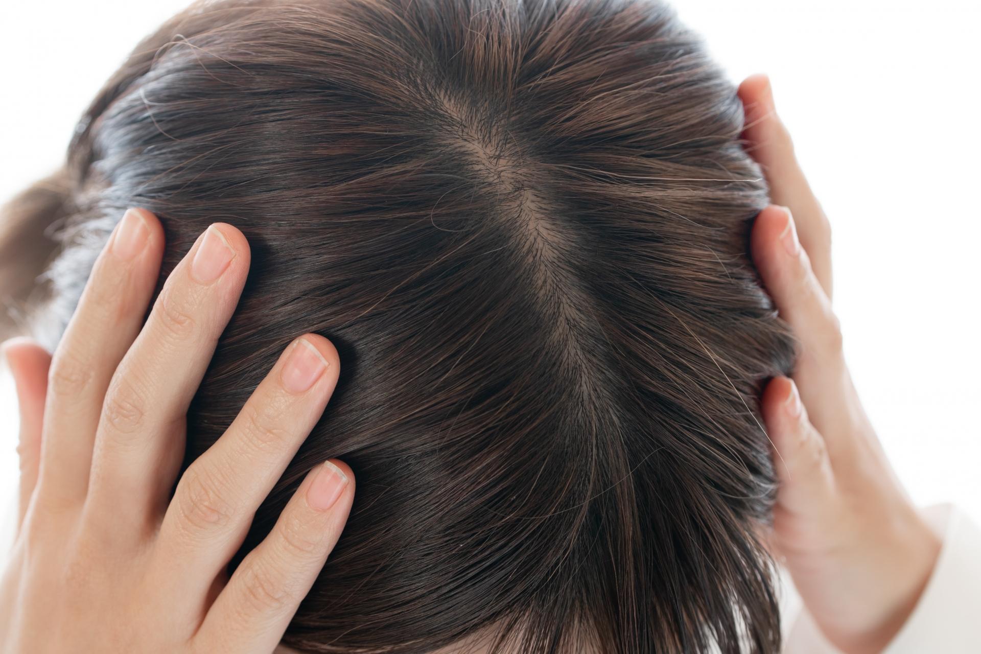 女性の分け目はげの原因｜見分け方の基準や予防・対策・治療法まで解説